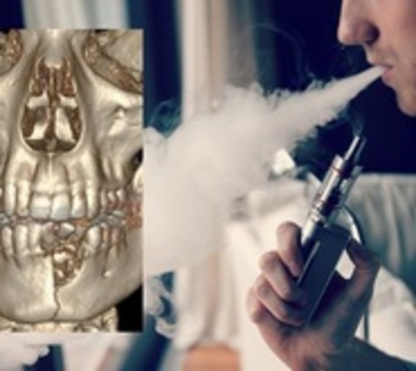 Le explotó el 'vape' y le rompió la mandíbula - Paraguay.com
