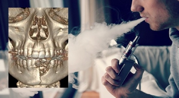 Le explotó el 'vape' y le rompió la mandíbula | Noticias Paraguay