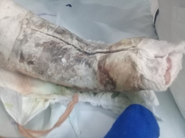 Operaron a un niño, le dejaron la herida abierta y sangrando, según denunció un papá