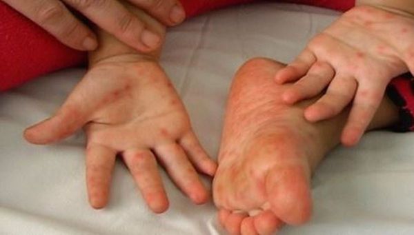 Advierten sobre virus de manos, pies y boca