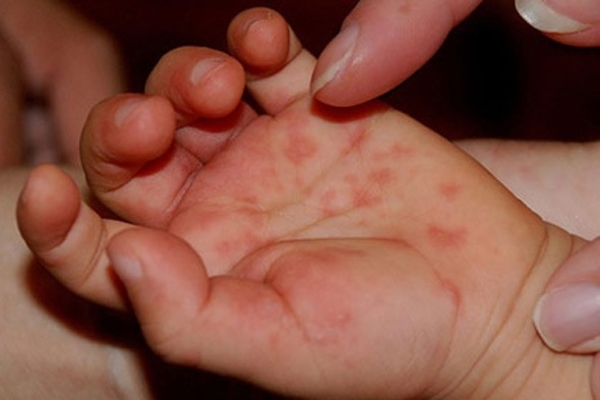Virus de manos, pies y boca, una enfermedad común en niños pequeños » Ñanduti