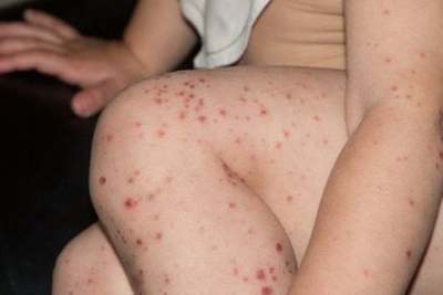Virus de manos, pies y boca, una enfermedad común en niños pequeños | San Lorenzo Py