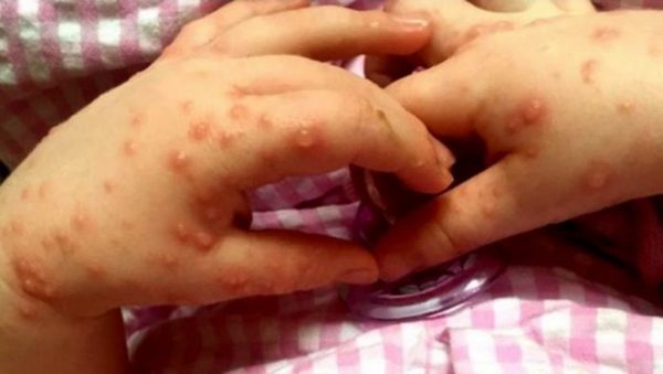 Enfermedad de manos, pies y boca es común en niños pequeños - ADN Paraguayo