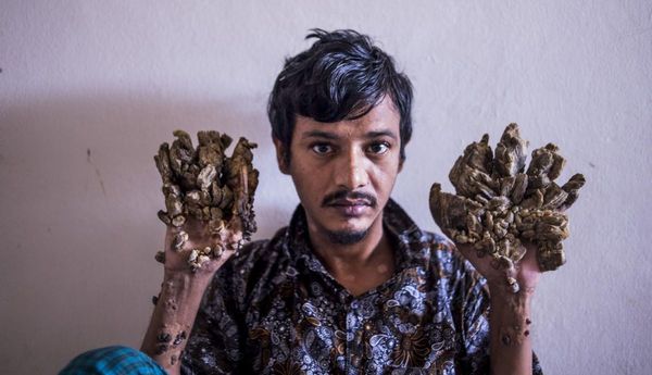 “Hombre-árbol” pide ser amputado