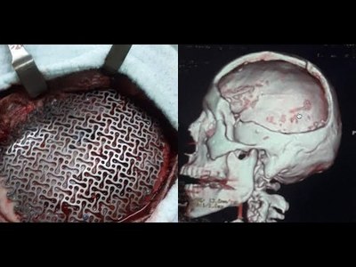 HISTÓRICA CIRUGÍA RECONSTRUCTIVA DE CRÁNEO EN EL HOSPITAL REGIONAL DE ENCARNACIÓN