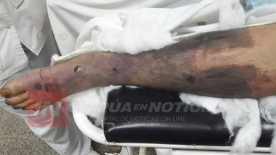 TERRIBLE: AMPUTAN PIERNA DE MENOR DE 16 AÑOS TRAS DUDOSO TRATAMIENTO