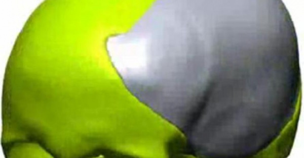 Joven tiene una cabeza ¡de titanio!