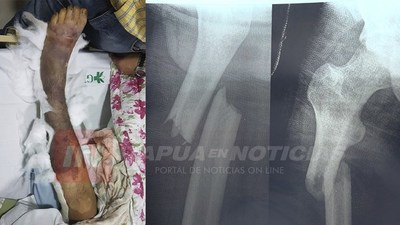 CASO AMPUTACIÓN: ELEVARÁN LOS ANTECEDENTES RESPECTIVOS PARA INVESTIGACIÓN.