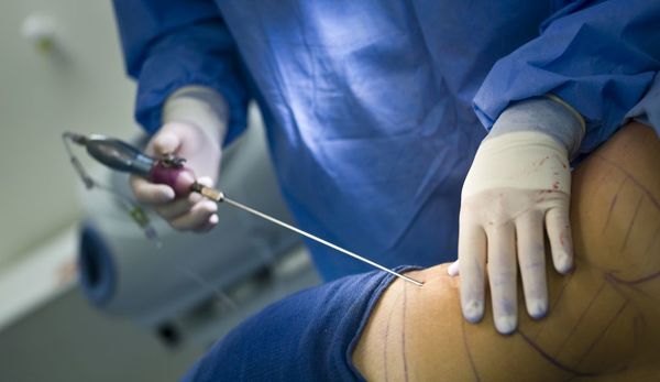 Lipoescultura fallida dejó secuelas en su cuerpo y denuncia mala praxis » Ñanduti