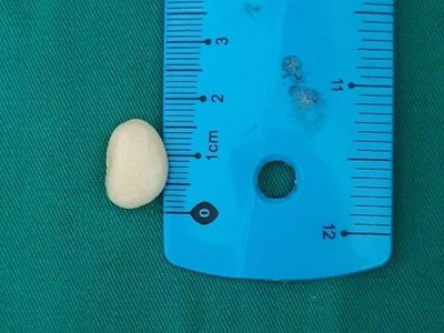 Niño en terapia intensiva por culpa de un poroto manteca
