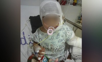 Beba quemada con agua hirviendo necesita ayuda para tratamiento