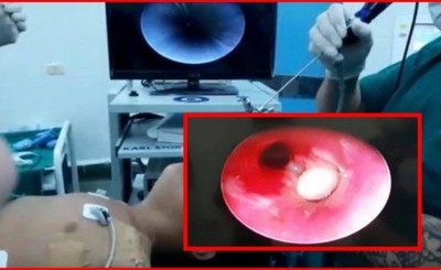 Niño queda en UTI por inhalar un poroto manteca