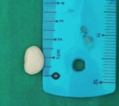 Niño en terapia por culpa de un poroto manteca - Paraguay.com