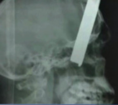 Incrustan metal en cabeza de guardia - Paraguay.com