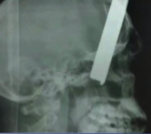 Incrustan metal en cabeza de guardia - Paraguay.com