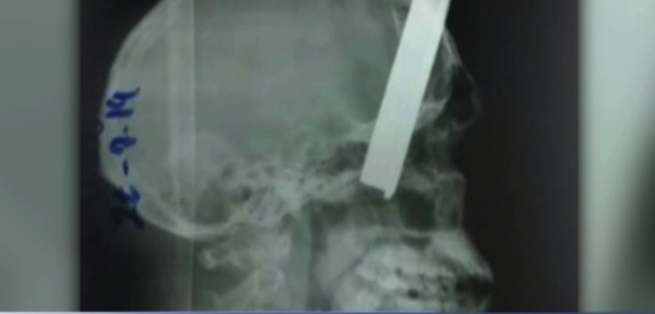 Le incrustró una varilla de metal en el cráneo | Noticias Paraguay