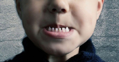 Extraen más de 500 dientes a un niño
