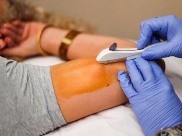 Hospital de Luque ya tiene fósforos anticonceptivos