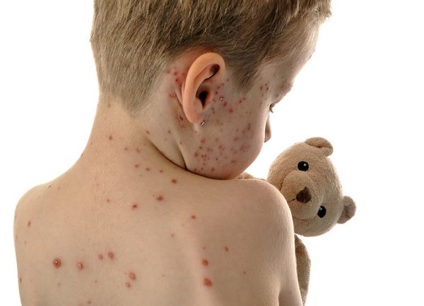 Alerta regional por casos de sarampión y fiebre amarilla