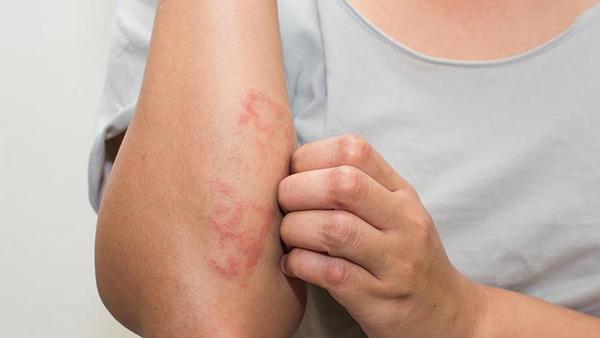 Clínicas: Aumentan las consultas por lesiones en la piel de manos y pies » Ñanduti