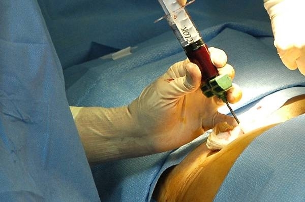 HOY / Donantes de médula óseas podrán formar parte de un registro mundial para curar la leucemia