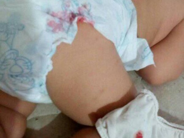 Vacunaron a un bebé con jeringa para adultos