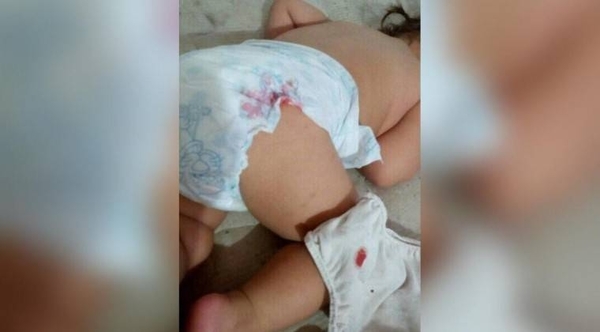 HOY / Inyectó a bebé con jeringa para adulto, infectó su pierna y lo dejaría con secuelas