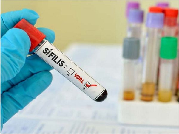 Los casos de sífilis superan el doble al VIH entre los jóvenes
