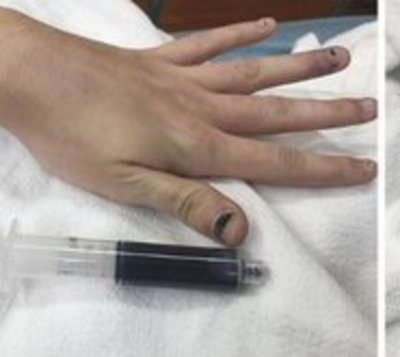 Anestésicos tiñeron de azul la sangre de una mujer - Paraguay.com