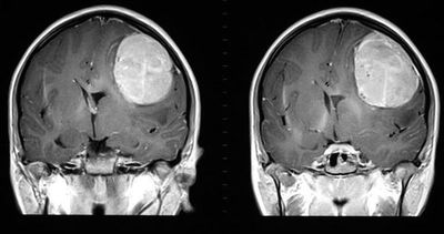 Hallan en ratones cómo neutralizar al glioblastoma, un letal tumor cerebral - Ciencia - ABC Color