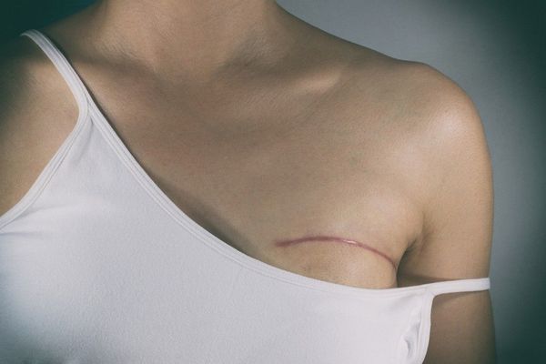 "Cáncer de mama sigue siendo la primera causa de mortalidad en mujeres" » Ñanduti