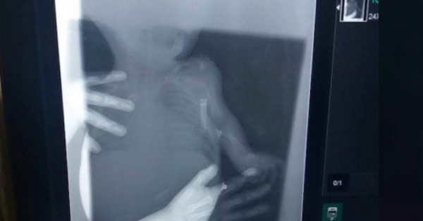 ¡En radiografía aparece un póra!