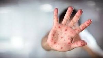 La ciudad de Nueva York declaró la emergencia sanitaria por un brote de sarampión