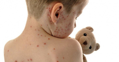 Cháke por posible epidemia de sarampión en el país he’i