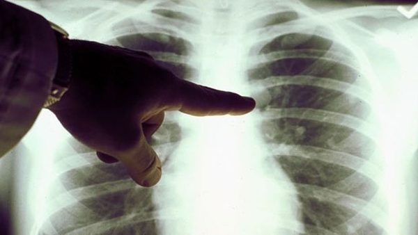 Luz roja para tratar el cáncer de pulmón | Noticias Paraguay