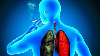 Paraguay: en código rojo por cáncer de pulmón