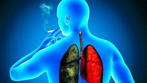 Paraguay: en código rojo por cáncer de pulmón