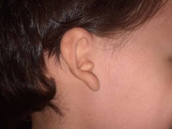 Más de 60 familias piden ayuda para tratar a niños con microtia