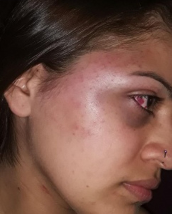 Mujer denuncia a su hermano por brutal golpiza pero fiscal no acciona - ADN Paraguayo