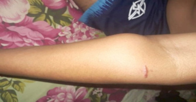 Vecino le dejó con el brazo chalái a joven
