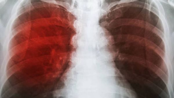 La tuberculosis se puede transmitir incluso en estado de latencia - Ciencia - ABC Color