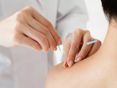 Ministerio de Salud analiza implementar el uso de la acupuntura
