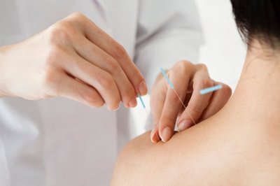 MINISTERIO DE SALUD ANALIZA IMPLEMENTAR EL USO DE LA ACUPUNTURA