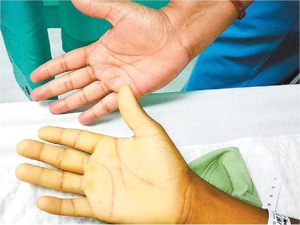 Anemia causa 115.000 muertes maternas en el mundo durante el parto al año