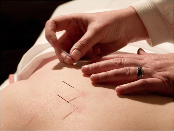 Salud busca reglamentar la acupuntura como especialidad médica