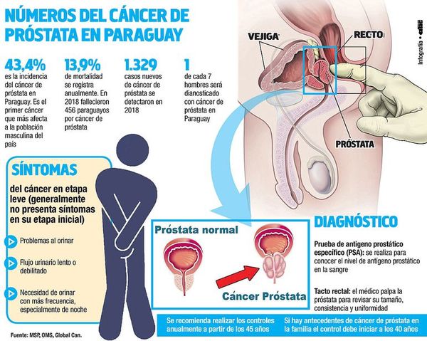 Cáncer de próstata, el más frecuente en la población masculina del país - Sociales - ABC Color