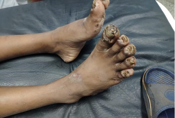 Rescatan a niño indígena con los pies y manos carcomidos por piques. Tiene una severa desnutrición - ADN Paraguayo