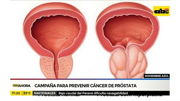 Cáncer de próstata: el más curable y el más mortal - Nacionales - ABC Color