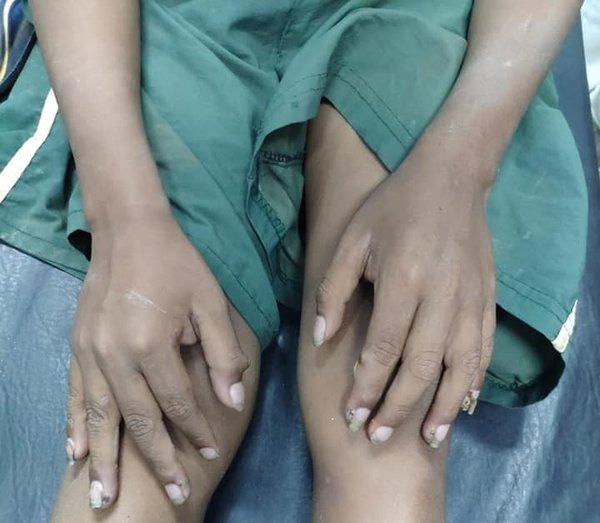 Rescatan a niño con dedos carcomidos por piques | Noticias Paraguay