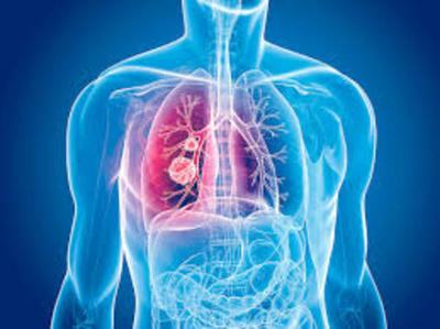 El cáncer de pulmón afecta de manera silenciosa » Ñanduti